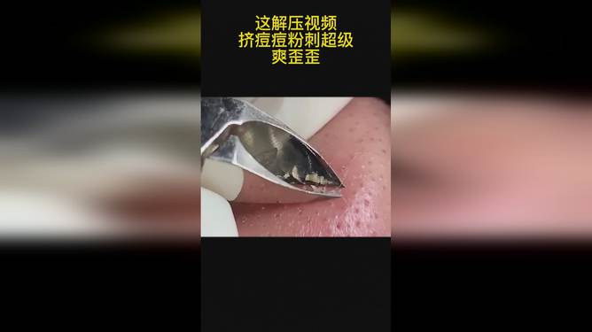 最新擠膿包視頻，見證變化的力量，自信與成就感的誕生之地